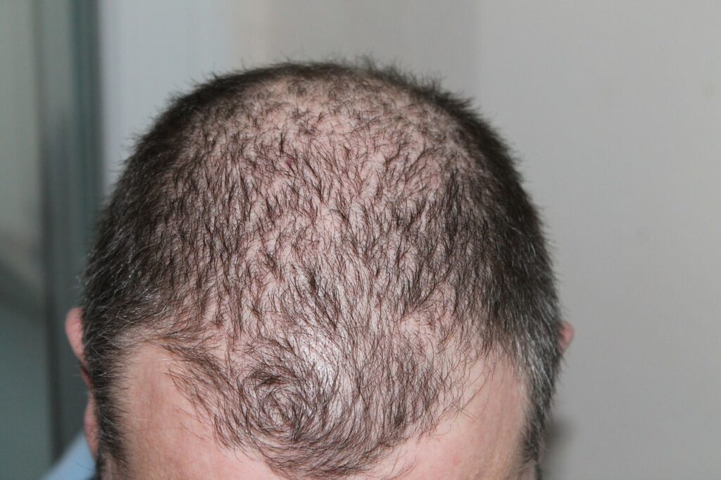 Excessive PMO causes hair loss and hair thinning