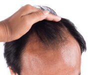 How to Stop Hair Loss and Hair Thinning: 6 Effective Steps