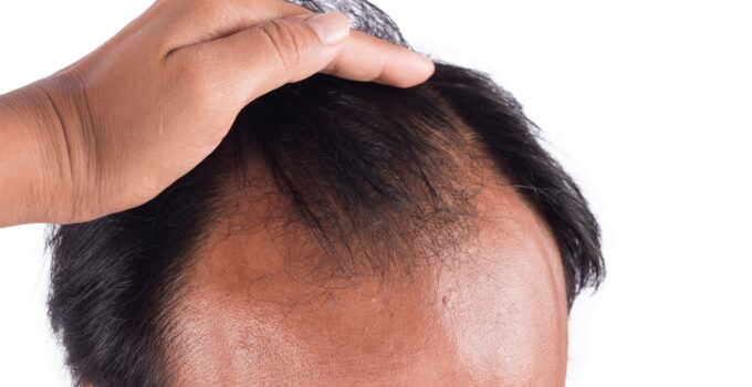 How to Stop Hair Loss and Hair Thinning: 6 Effective Steps