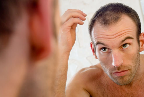 hair loss in men