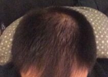 NoFap Hair loss: Can NoFap Stop Hair Loss & Regrow Hair? Explained